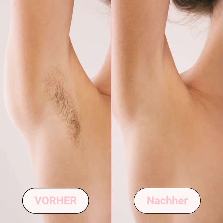 Removely IPL – Testen & Kaufen