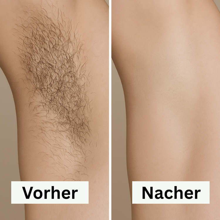 Removely IPL – Testen & Kaufen