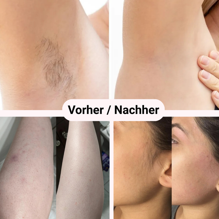 Removely IPL – Testen & Kaufen